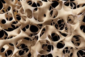 Ostseoporose bei einer Knochendichtemessung